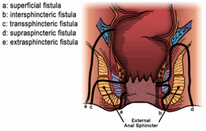 Anal Fistula Diagram