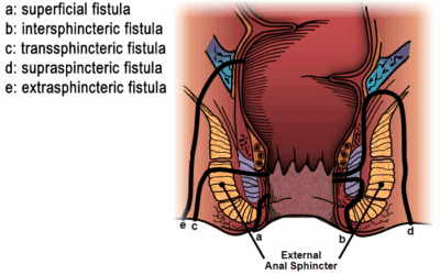 Anal Fistula Questions & Answers